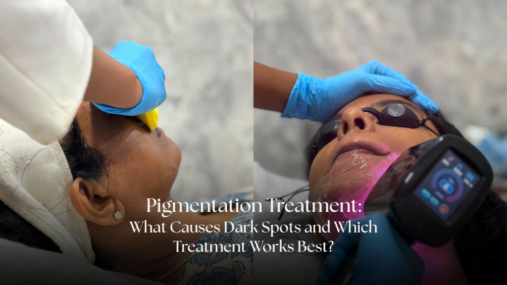 Pigmentation Treatment: What Causes Dark Spots and Which Treatment Works Best?